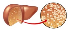 당뇨병 치료제가 비알콜성 지방간염(nonalcoholic steatohepatitis)을 억제 연구 결과 발표