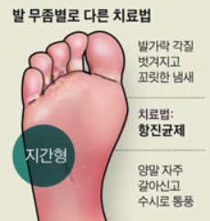 발가락 사이를 좀 먹는 ‘좀벌레’ 무좀 그 정체는?