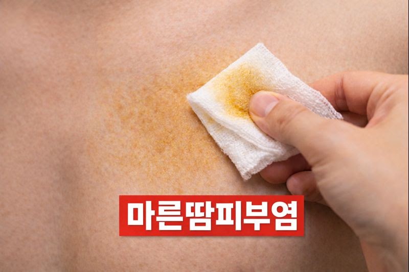 물로 안 지워지는 ‘노란 자국’ 정체는 마른땅피부염? 알코올로 닦이면 사라지는 이유