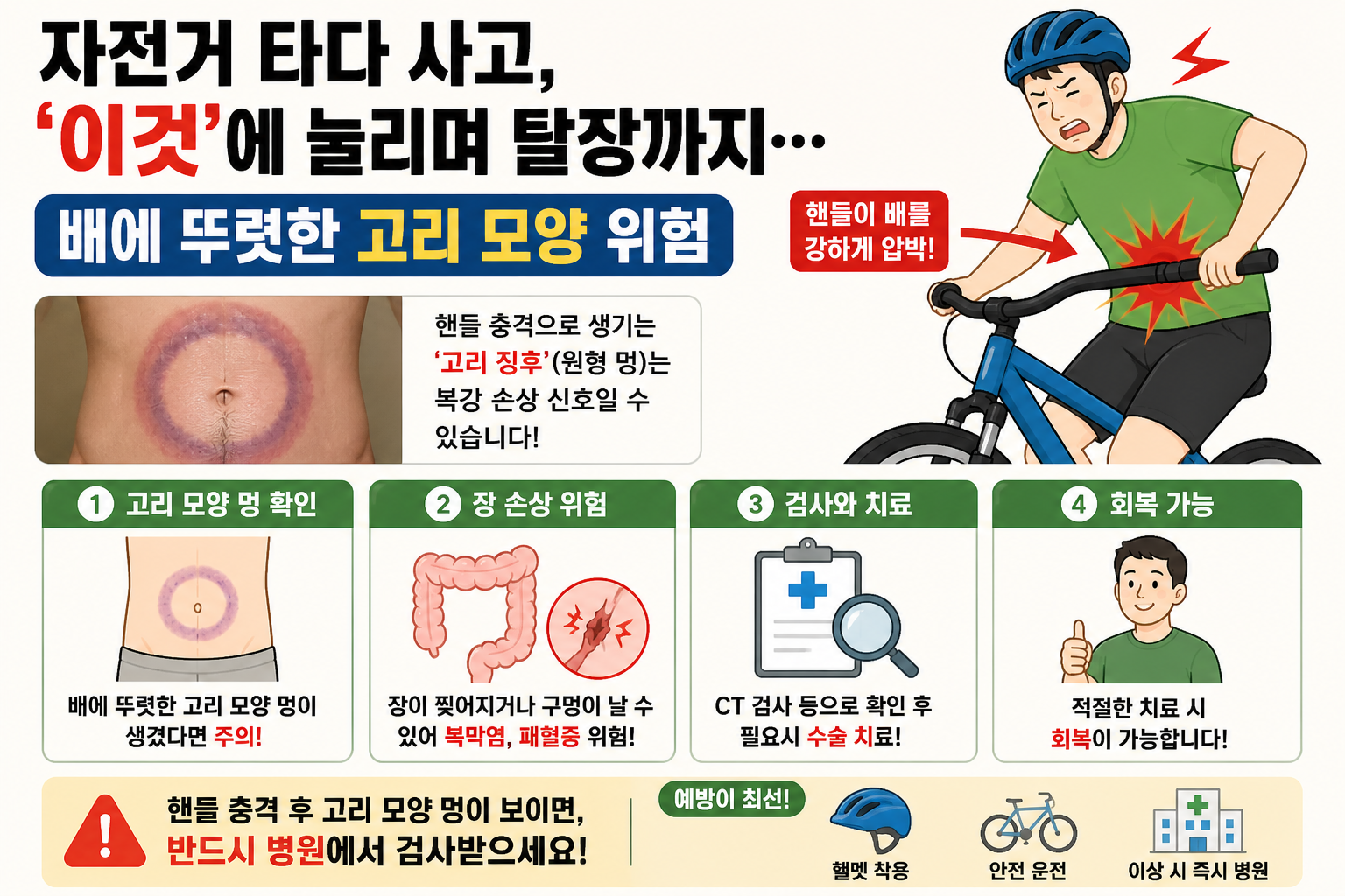 자전거 사고 후 배에 고리 멍 생겼다면 위험…핸들 충격, 탈장·장손상 부른다