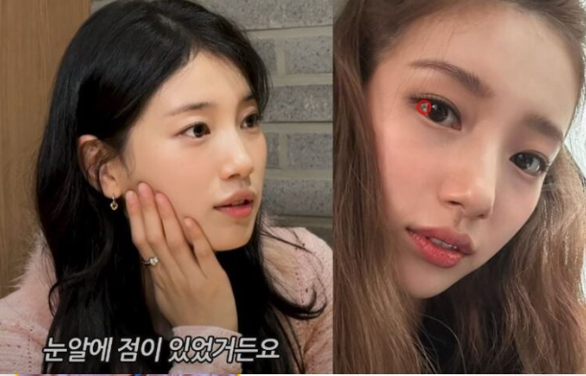 수지 흰자위 점 ‘결막모반’ 제거—원인·위험 신호·레이저·수술·재발 관리 총정리