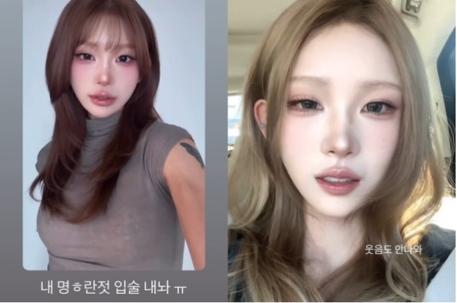 최준희 입술 필러 제거 고백…효과·부작용·관리법·히알루로니다아제로 녹이는 법 총정리