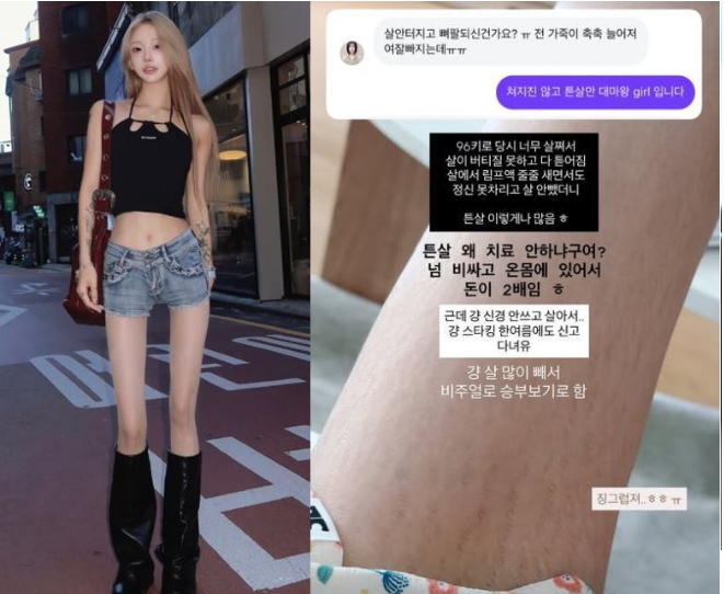 최준희 45kg 감량 후 ‘튼살’ 공개: 림프액 오해 해설·레이저 치료와 예방 팁